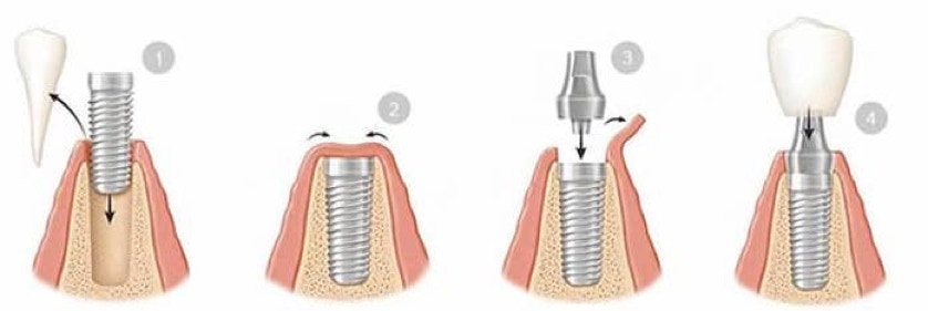 Summary of the Dental Implant Process 