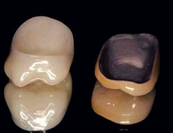 An Zirconia Porcelain Crown and a Porcelain Bonded to Metal Crown