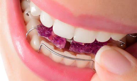 A Removovable Orthodontic Brace