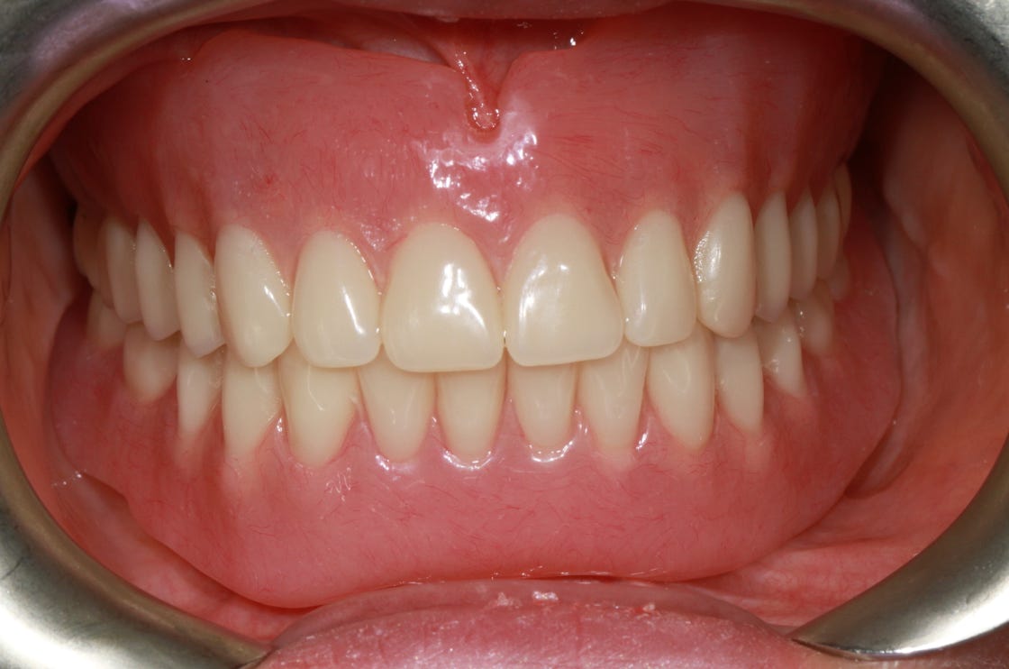Upper and Lower Full Dentures