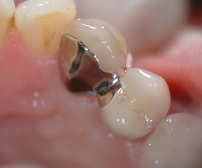 An Adhesive Bridge Bonded in the Mouth