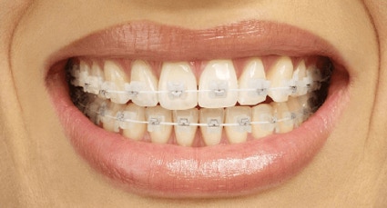 Tooth Coloured Fixed (Train Tracks) Orthodontic Braces