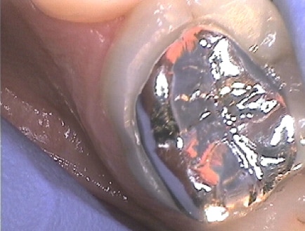 A Silver Metal Coloured Dental Restoration