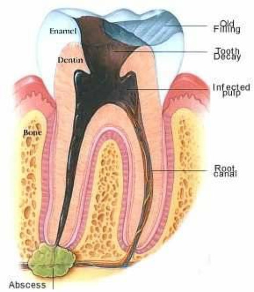 Decay as a cause of a dental abscess