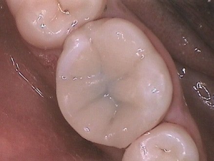 A Tooth Coloured Composite Filling (that replaced the metal filling shown adjacent)