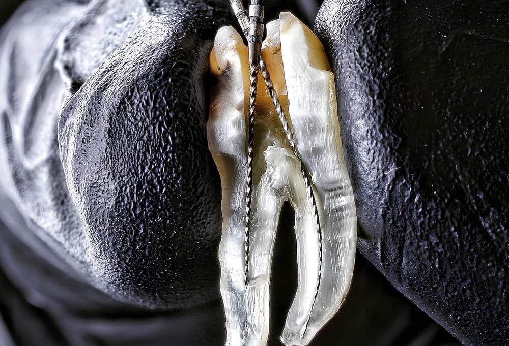 Root Canal