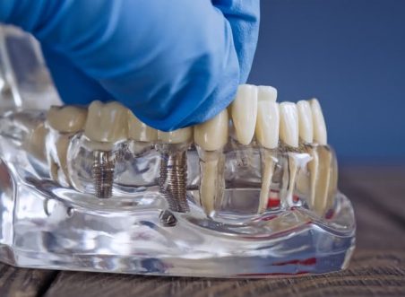Modern Solutions for Tooth Loss: A Guide to Dental Implants for Wokingham Residents