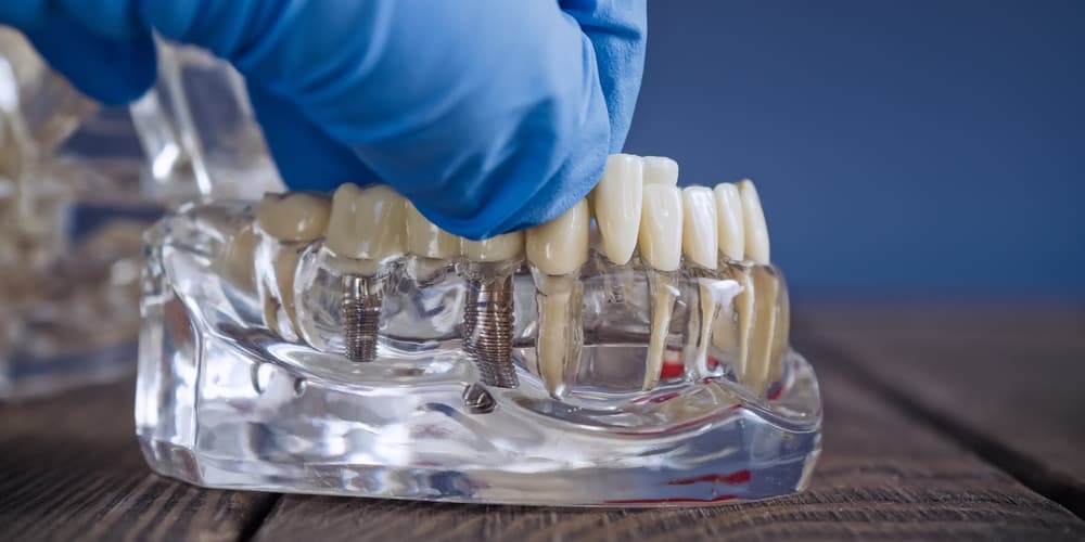 Dental Implants Wokingham