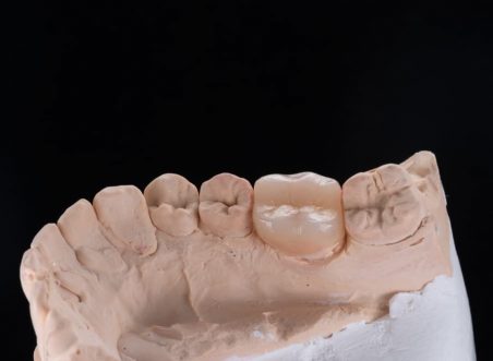 Why “Less is More” in Modern Dentistry: The Power of Biomimetic Natural Tooth Restoration