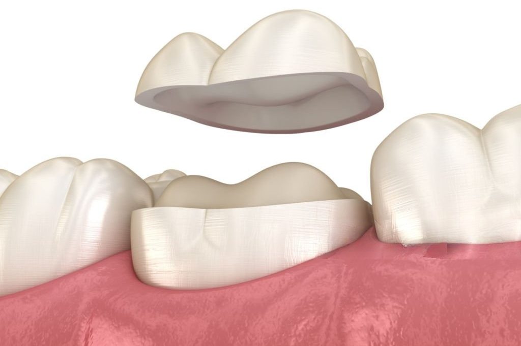 Dental Onlay