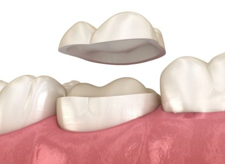 What Is a Dental Onlay and Why Is It Needed After a Root Canal?