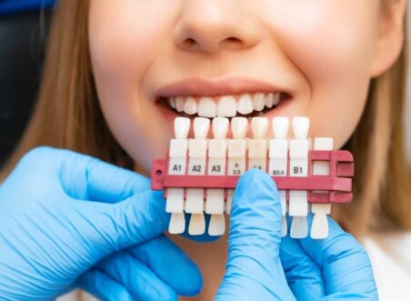 What to Expect During a Veneer Consultation