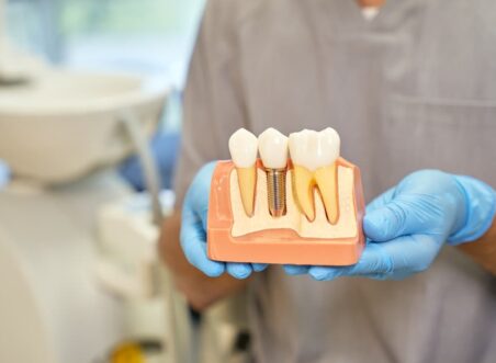 How Dental Implants Become a Long-Term Part of Your Smile