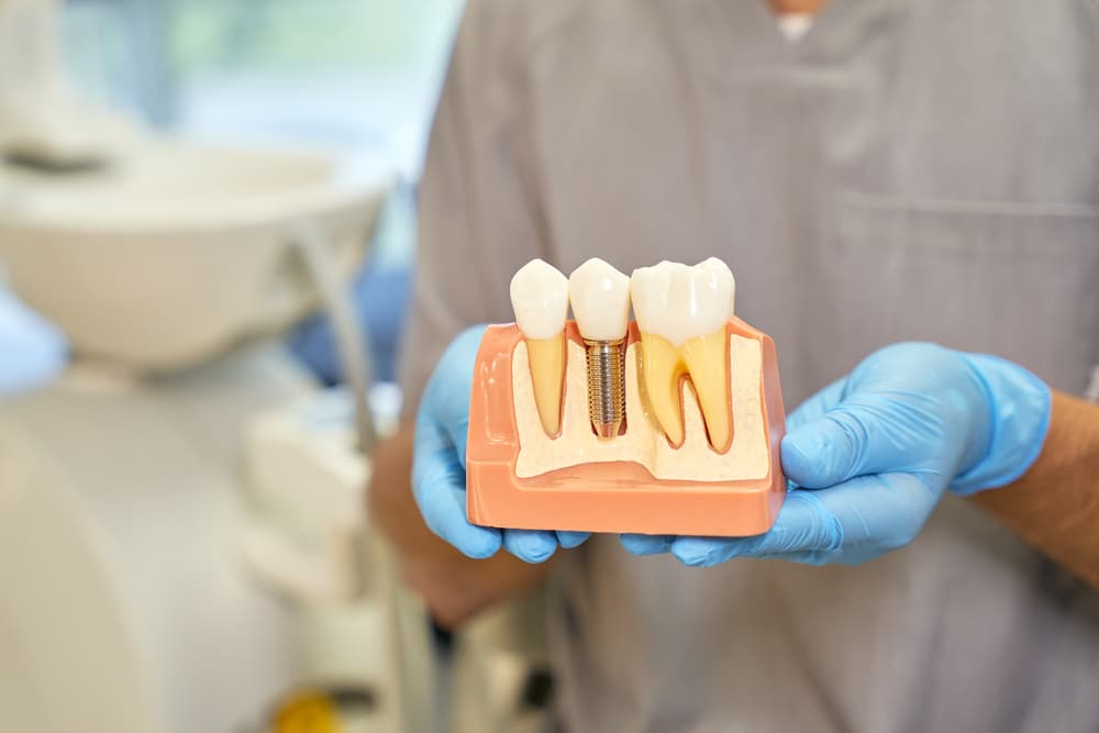 Dental Implants