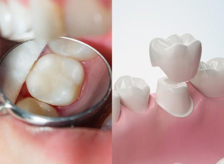 Biomimetic Dentistry vs Traditional Fillings and Crowns: Which Is Better for Your Tooth?