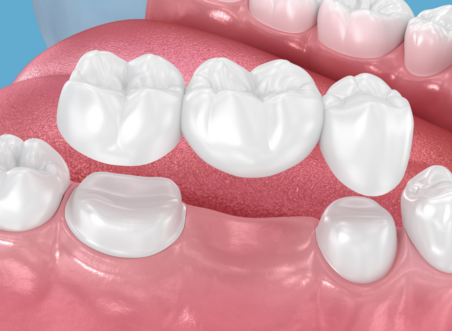 Dental Bridges Explained: Resin-Bonded vs Conventional