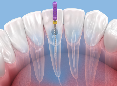 Root Canal Treatment: What to Expect, Step by Step
