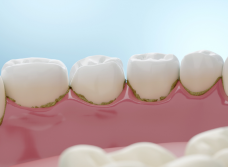 Dental Calculus (Tartar): What It Is, How to Remove It and How to Prevent It