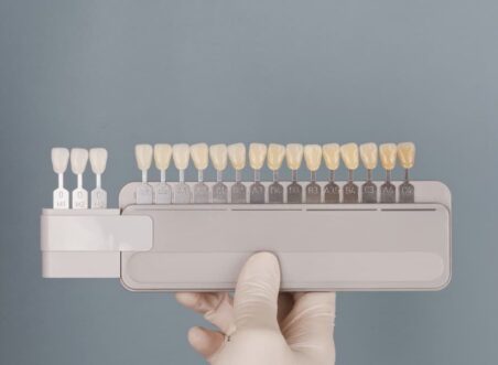 Why Veneers Are Popular in Cosmetic Dentistry