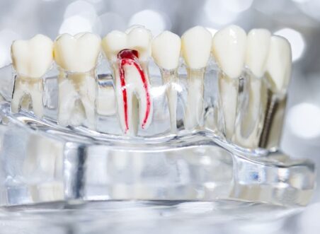Root Canal vs Tooth Extraction Which Is Better