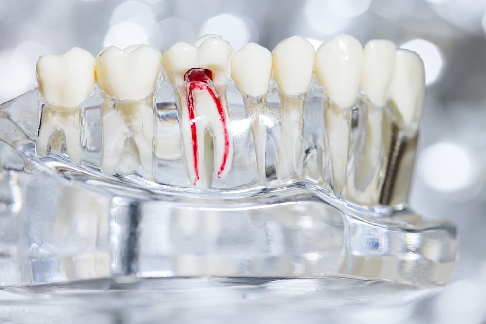 root canal treatment